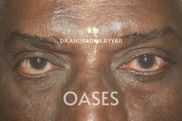 Eyelid Lumps – After Treatment