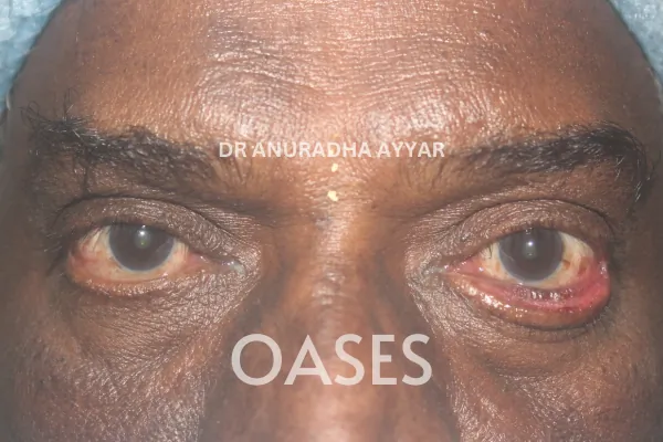 Eyelid Lumps – Before Treatment