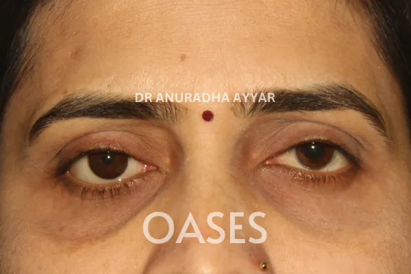 Eyelid Lumps – After Treatment