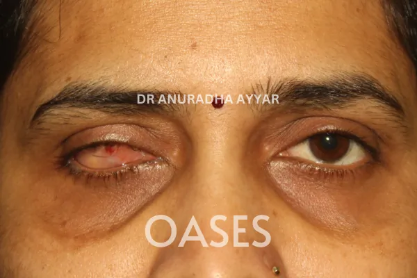 Eyelid Lumps – Before Treatment