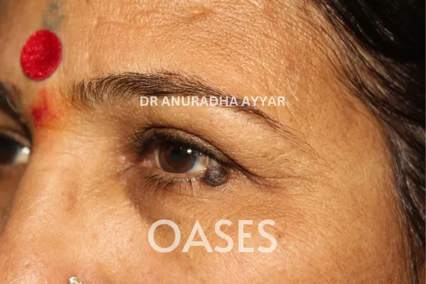 Blepharoplasty – Before Treatment