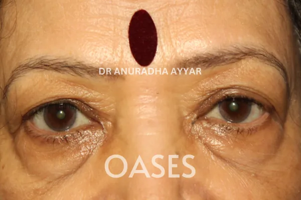 Blepharoplasty – Before Treatment