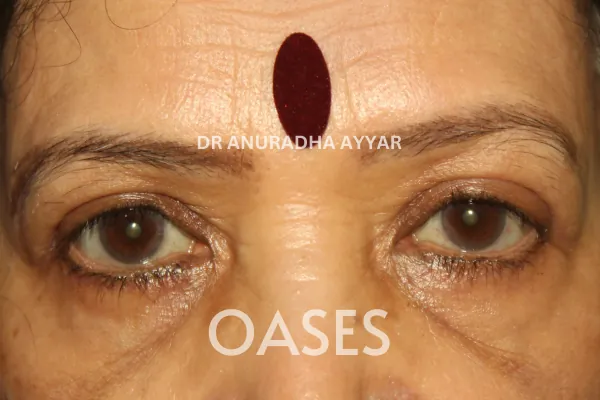 Blepharoplasty – After Treatment