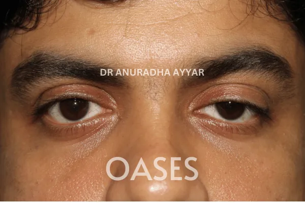 Ptosis – Before Treatment