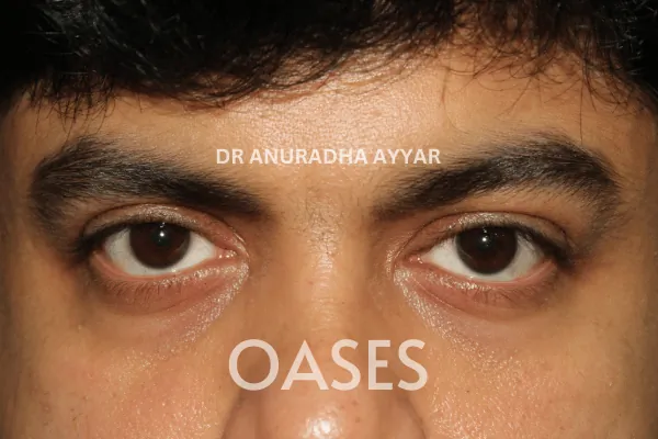 Ptosis – After Treatment
