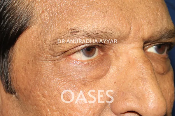 Skin Tags Treatment at Oases Eye Care Center