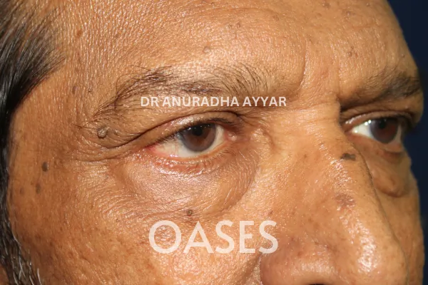 Skin Tags Treatment at Oases Eye Care Center