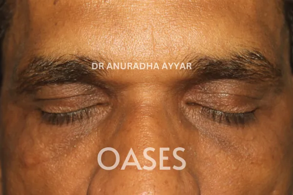 Xanthelasma Treatment at Oases Eye Care Center