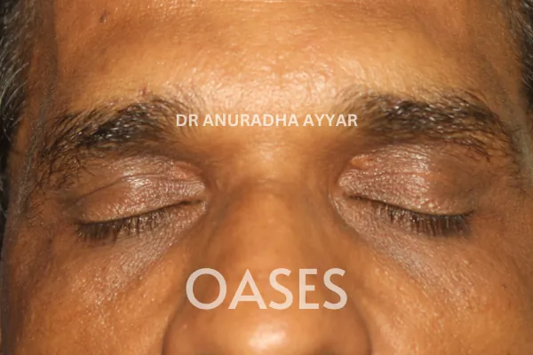 Xanthelasma Treatment at Oases Eye Care Center