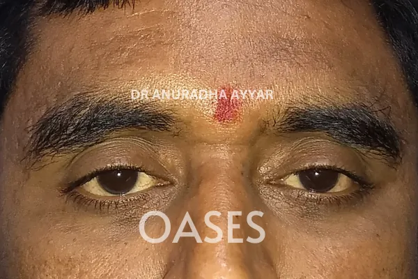Xanthelasma Treatment at Oases Eye Care Center