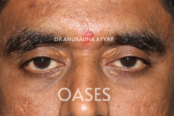 Xanthelasma Treatment at Oases Eye Care Center