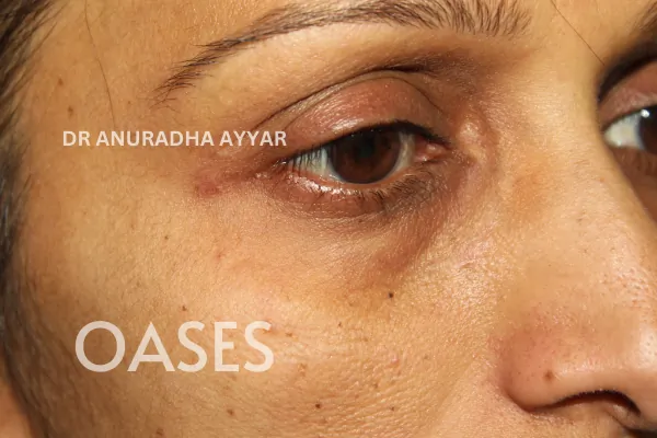 Xanthelasma Treatment at Oases Eye Care Center