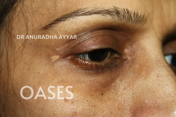Xanthelasma Treatment at Oases Eye Care Center