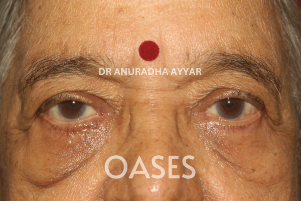 Entropion Treatment at Oases Eye Care Center