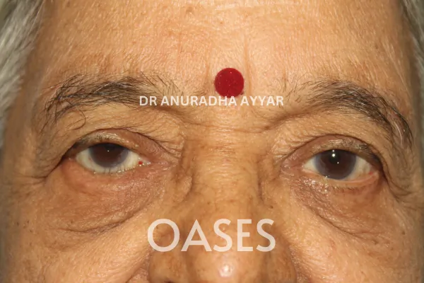 Entropion Treatment at Oases Eye Care Center