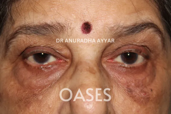 Entropion Treatment at Oases Eye Care Center