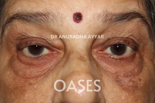 Entropion Treatment at Oases Eye Care Center