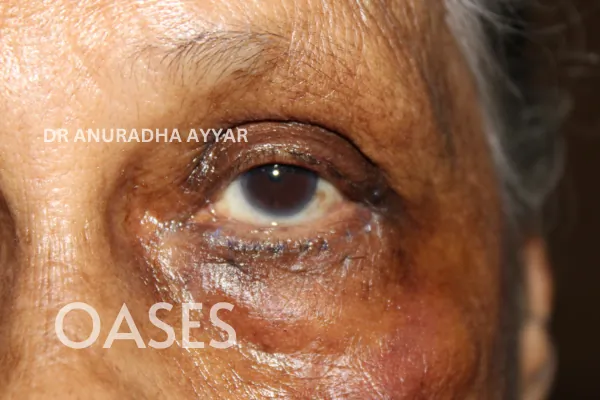 Entropion Treatment at Oases Eye Care Center