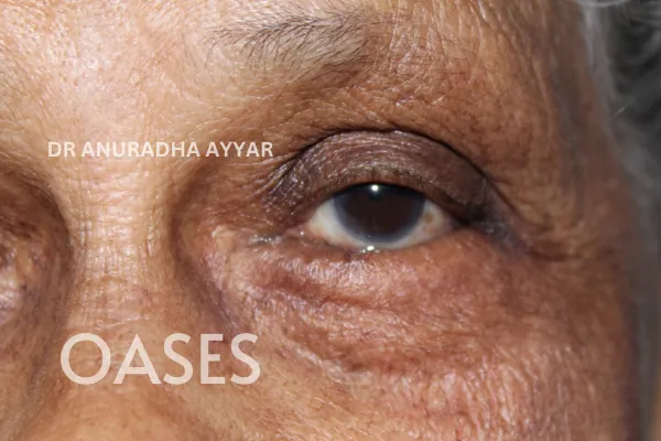 Entropion Treatment at Oases Eye Care Center