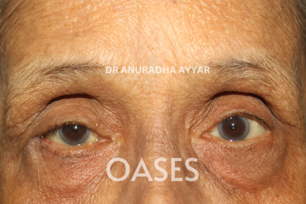 Entropion Treatment at Oases Eye Care Center