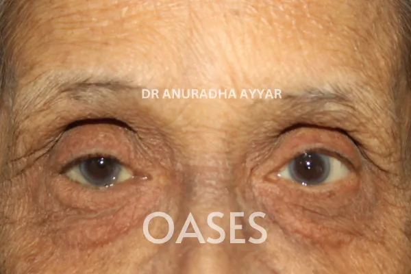 Entropion Treatment at Oases Eye Care Center