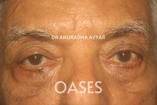 Entropion Treatment at Oases Eye Care Center