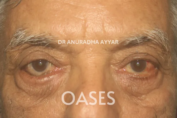 Entropion Treatment at Oases Eye Care Center