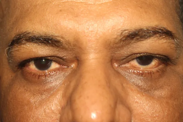Rare cases Treatment at Oases Eye Care Center