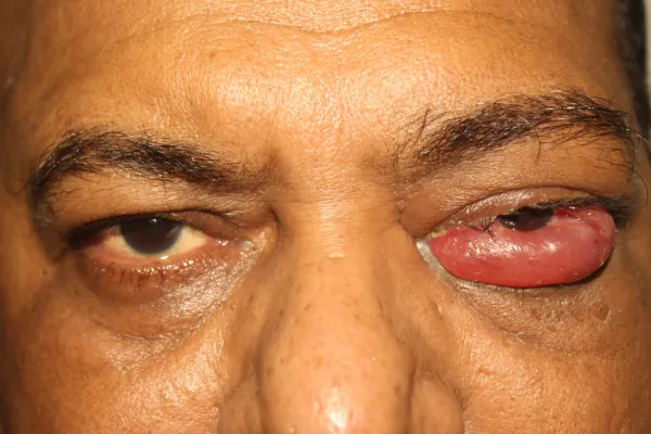 Rare cases Treatment at Oases Eye Care Center