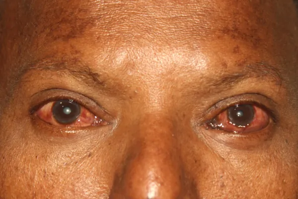 Rare cases Treatment at Oases Eye Care Center
