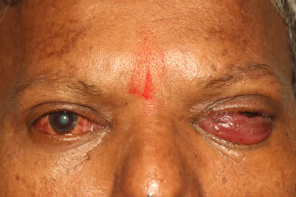 Rare cases Treatment at Oases Eye Care Center