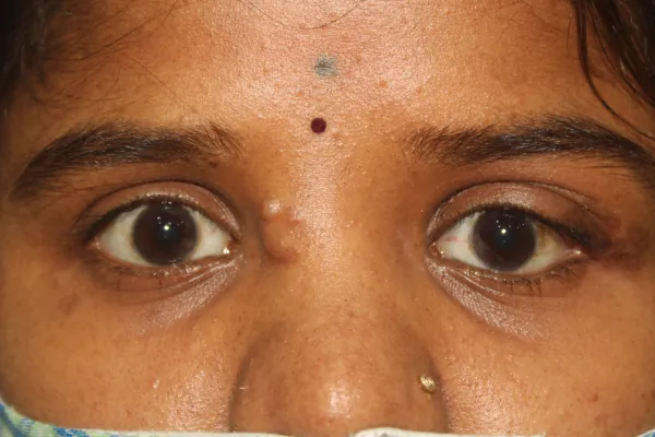 Rare cases Treatment at Oases Eye Care Center