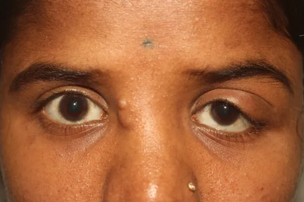 Rare cases Treatment at Oases Eye Care Center