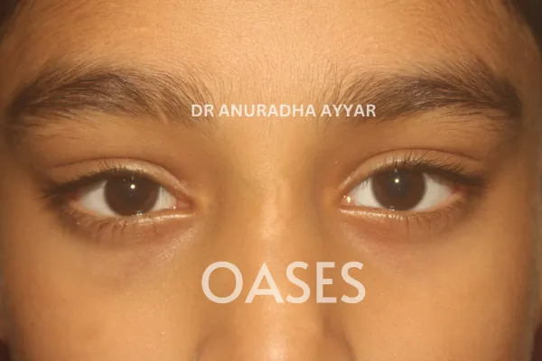 Trauma Treatment at Oases Eye Care Center