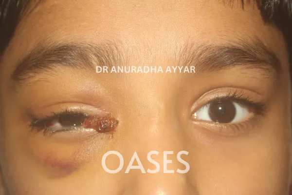 Trauma Treatment at Oases Eye Care Center