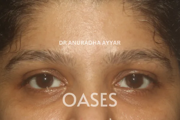 Trauma Treatment at Oases Eye Care Center