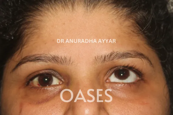 Trauma Treatment at Oases Eye Care Center