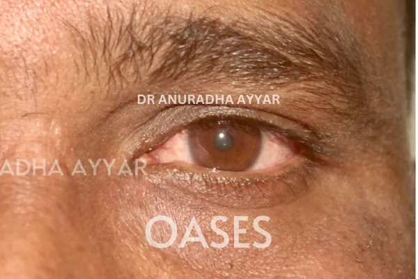 Watering Eyes Treatment at Oases Eye Care Center