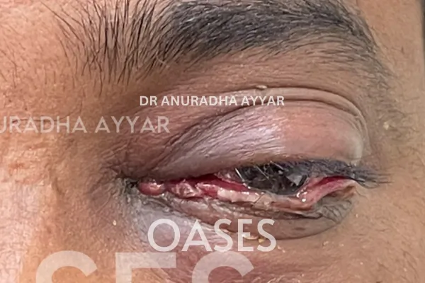 Watering Eyes Treatment at Oases Eye Care Center