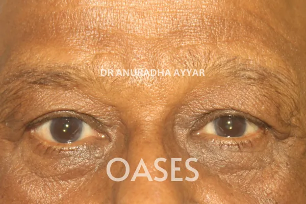 Watering Eyes Treatment at Oases Eye Care Center
