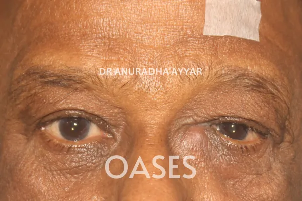 Watering Eyes Treatment at Oases Eye Care Center