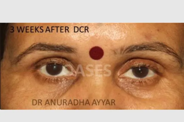 Watering Eyes Treatment at Oases Eye Care Center