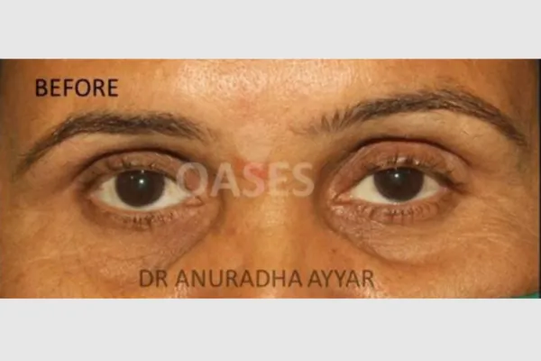 Watering Eyes Treatment at Oases Eye Care Center