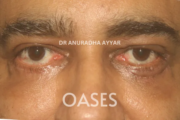 Ptosis Treatment at Oases Eye Care Center