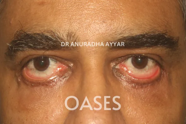 Ptosis Treatment at Oases Eye Care Center