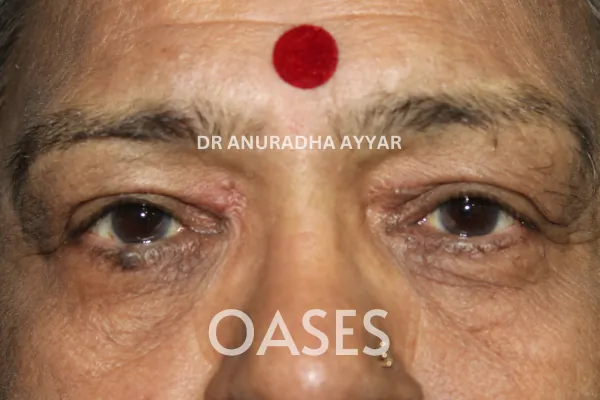 Ptosis Treatment at Oases Eye Care Center