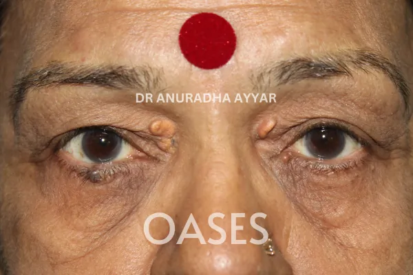 Ptosis Treatment at Oases Eye Care Center