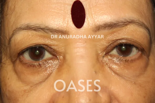 Blepharoplasty Treatment at Oases Eye Care Center