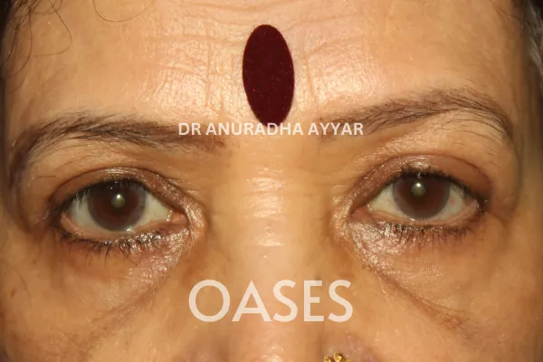 Blepharoplasty Treatment at Oases Eye Care Center