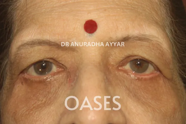 Ptosis Treatment at Oases Eye Care Center
